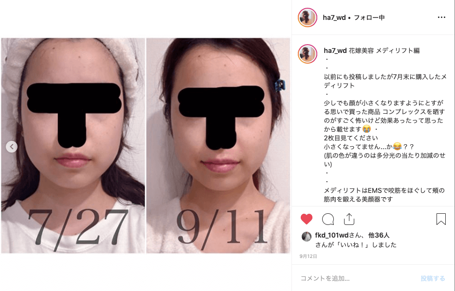 グランドハイアット東京の花嫁さんがメディリフトを使って3ヶ月で小顔